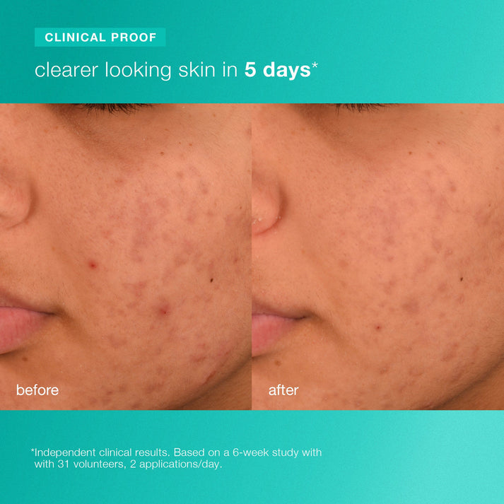 Breakout Biotic Moisturizer - Sylph Beauty