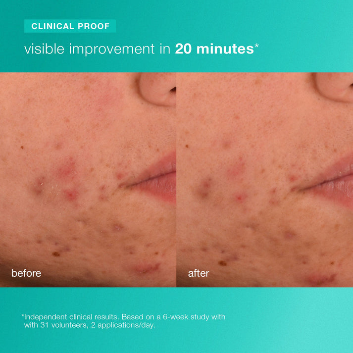 Breakout Biotic Moisturizer - Sylph Beauty